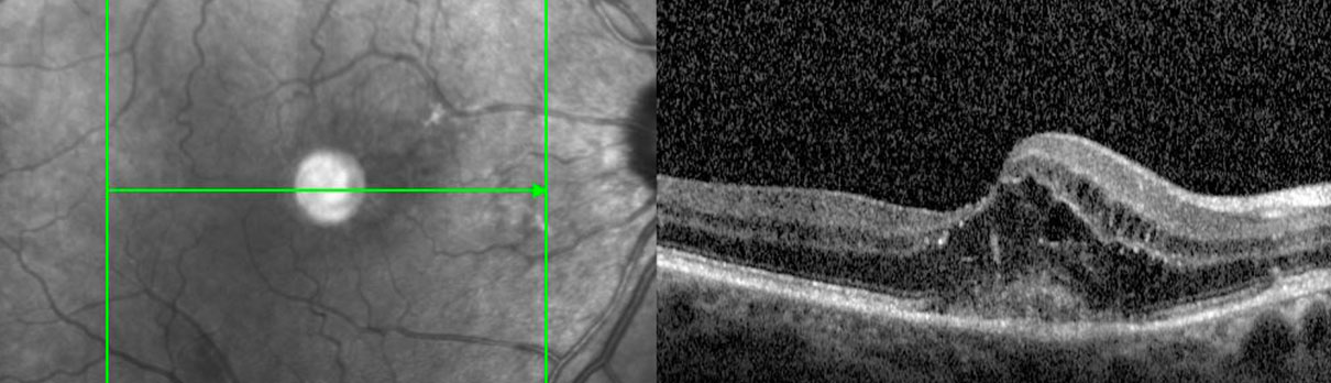 https://garetina.com/wp-content/uploads/age-related-macular-degeneration-1.jpeg