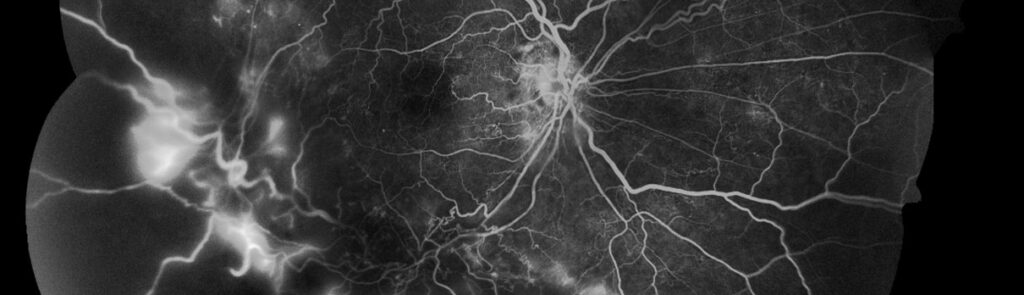 Example of Branch Retinal Vein Occlusion