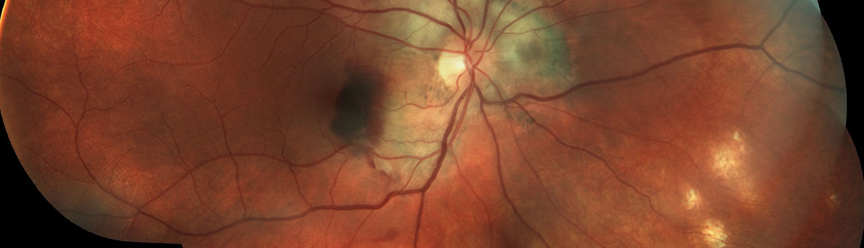 Example of Ocular Histoplasmosis