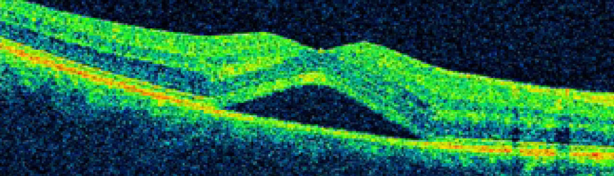 Example of Central Serous Retinopathy