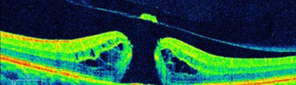 Example of Macular Holes