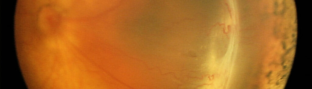 Example of Retinopathy of Prematurity