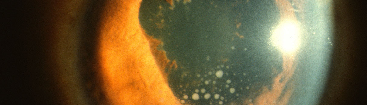 Example of Uveitis